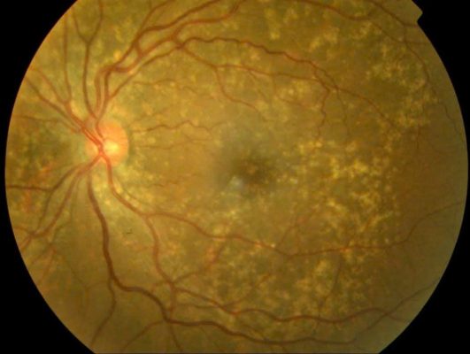 Hình ảnh chụp đáy mắt AMD thể khô
