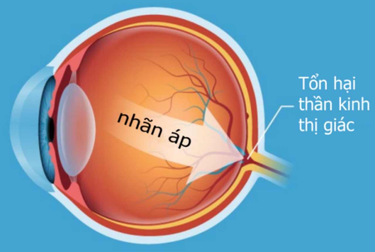 BỆNH VIỆN MẮT TỈNH NAM ĐỊNH HƯỞNG ỨNG TUẦN LỄ GLÔCÔM THẾ GIỚI NĂM 2021 (07-13/3/2021)