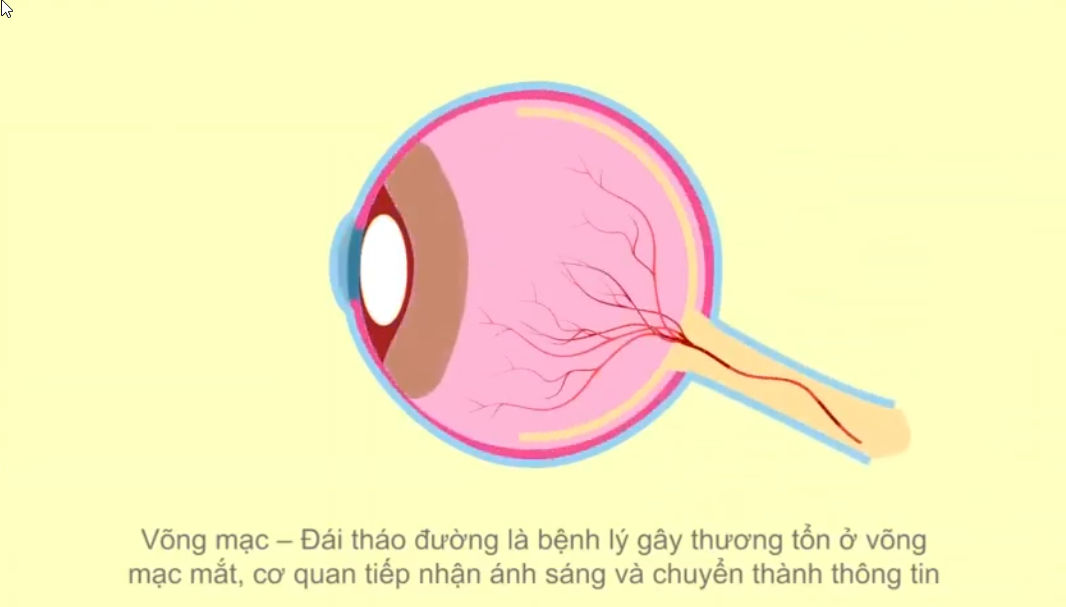 Vấn đề về mắt với bệnh nhân Đái tháo đường